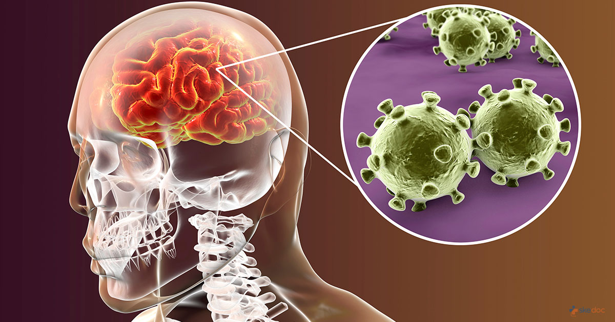 Viral meningitis